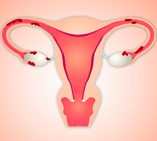 Эндометриоз матки лечение, симптомы, причины